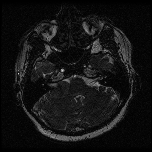 Acoustic schwannoma (Radiopaedia 33045-34060 Axial T2 26).png