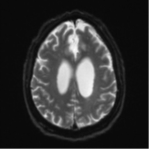 Acoustic schwannoma (Radiopaedia 55729-62281 E 20).png