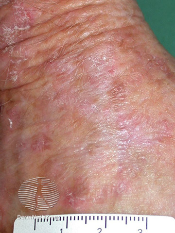 File:Actinic keratoses affecting the hands (DermNet NZ lesions-ak-hands-529).jpg