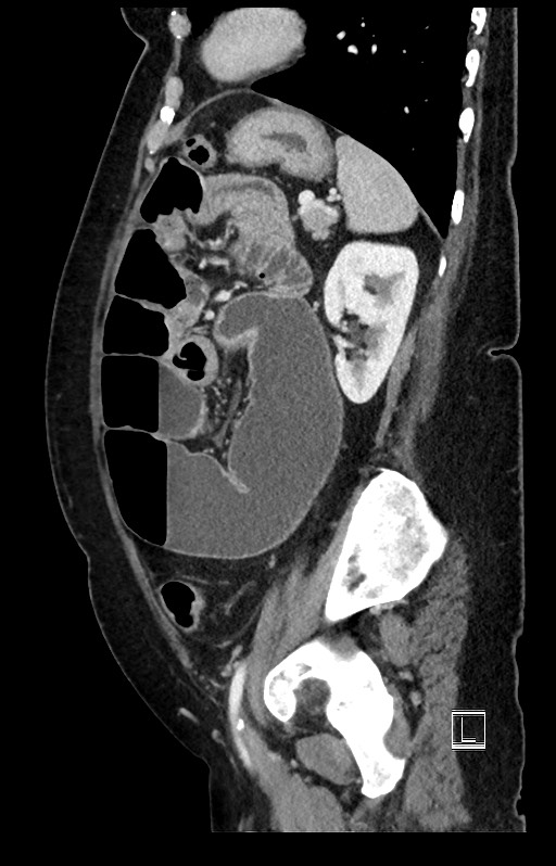 Active Crohn disease (Radiopaedia 59394-66750 Sagittal C+ portal venous phase 17).jpg