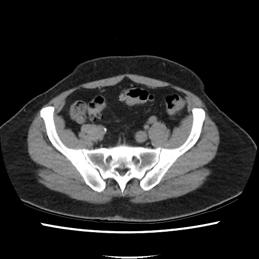 Active colonic bleed on CT (Radiopaedia 49765-55025 Axial non-contrast 63).jpg