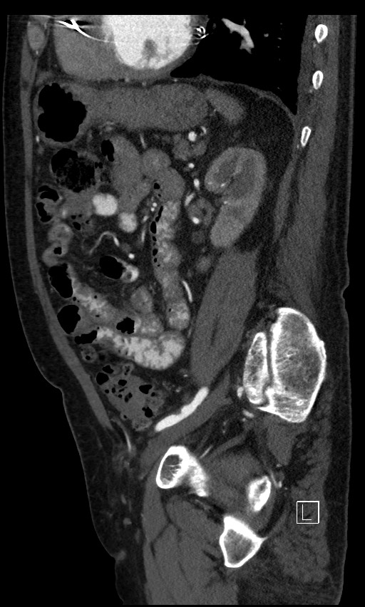 Active lower gastrointestinal bleeding - diverticular (Radiopaedia 61203-69106 Sagittal C+ arterial phase 55).jpg