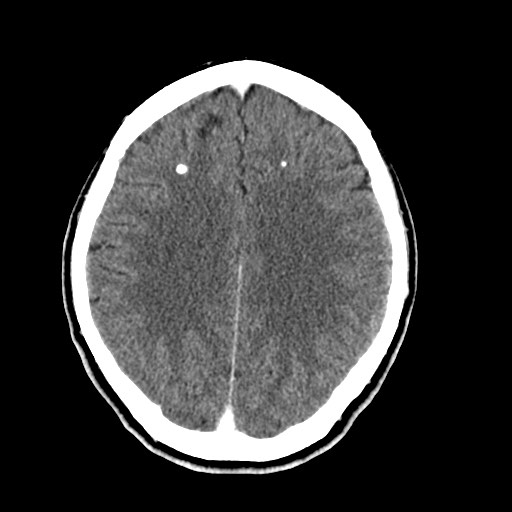 File:Active neurocysticercosis before and after therapy (Radiopaedia 71710-82099 Axial C+ delayed 33).jpg