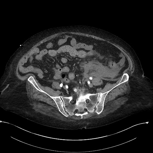 File:Active renal extravasation with large subcapsular and retroperitoneal hemorrhage (Radiopaedia 60975-68796 Axial C+ arterial phase 140).jpg