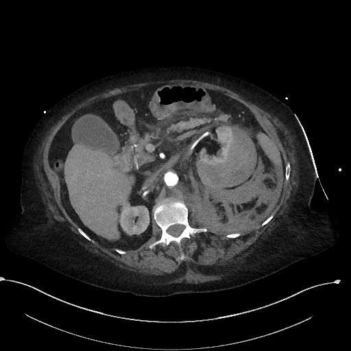 Active renal extravasation with large subcapsular and retroperitoneal hemorrhage (Radiopaedia 60975-68796 Axial C+ arterial phase 72).jpg