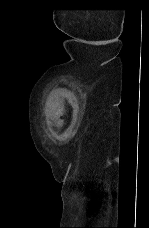 Active renal extravasation with large subcapsular and retroperitoneal hemorrhage (Radiopaedia 60975-68796 Sagittal C+ portal venous phase 203).jpg