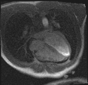 Active right ventricular cardiac sarcoidosis (Radiopaedia 55596-62100 Axial Dynamic perfusion scan MOCO 79).jpg