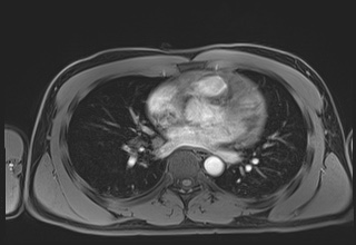 File:Active right ventricular cardiac sarcoidosis (Radiopaedia 55596-62100 Axial Post contrast Dixon 40).jpg