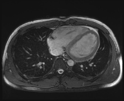 File:Active right ventricular cardiac sarcoidosis (Radiopaedia 55596-62100 Axial SSFP 7).jpg