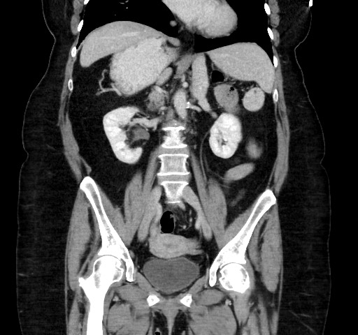 Acute appendicitis, heterotaxy syndrome (Radiopaedia 66884-76202 Coronal C+ portal venous phase 68).jpg