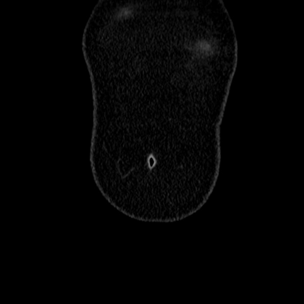 File:Acute appendicitis (Radiopaedia 38255-40270 Coronal C+ portal venous phase 6).jpg