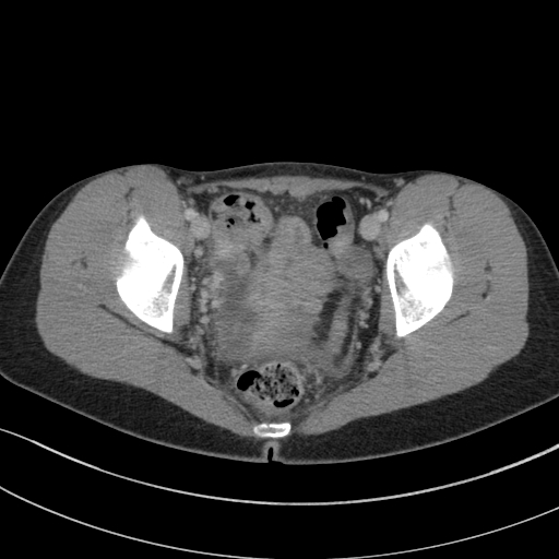 Acute appendicitis (Radiopaedia 62608-70901 Axial C+ portal venous phase 46).jpg