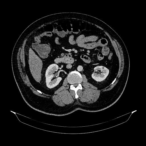 Acute appendicitis (Radiopaedia 79950-93224 Axial C+ portal venous phase 47).jpg