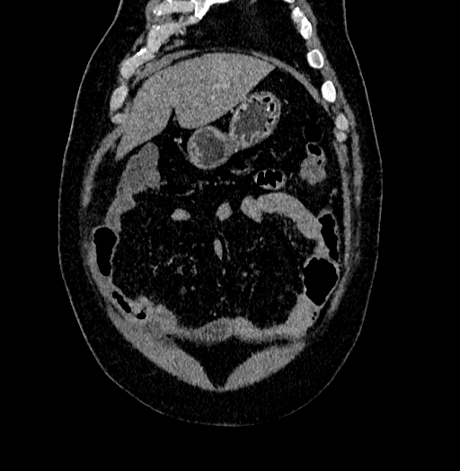 Acute appendicitis (Radiopaedia 79950-93224 Coronal C+ portal venous phase 15).jpg