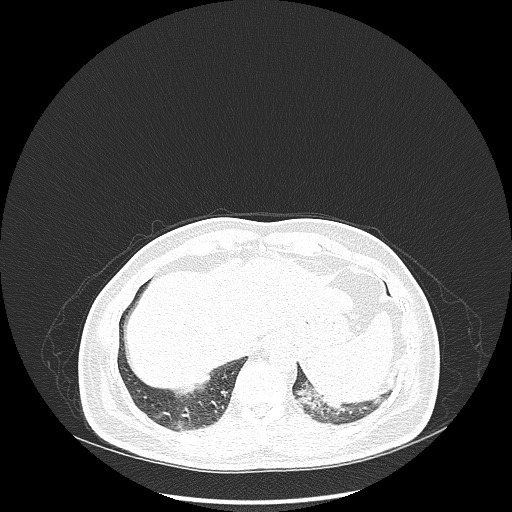 Acute appendicitis and COVID 19 pneumonia (Radiopaedia 76604-88380 Axial lung window 48).jpg