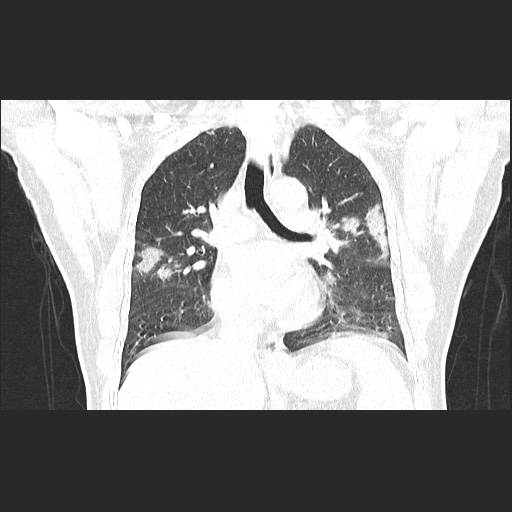 Acute appendicitis and COVID 19 pneumonia (Radiopaedia 76604-88380 G 34).jpg