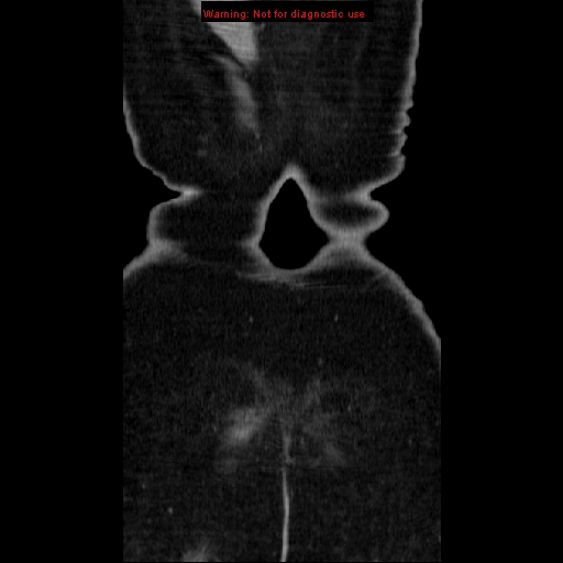 File:Acute appendicitis complicated by ovarian vein thrombophlebitis (Radiopaedia 16172-15851 Coronal C+ portal venous phase 84).jpg
