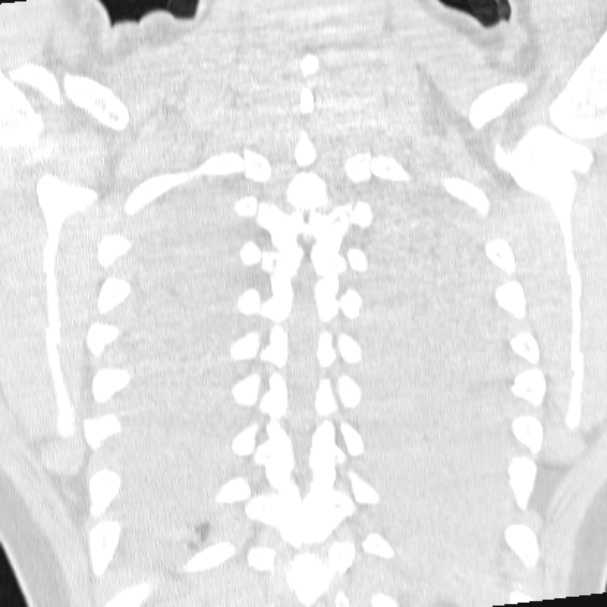 Acute aspiration pneumonitis (Radiopaedia 33605-34703 Coronal lung window 67).jpg