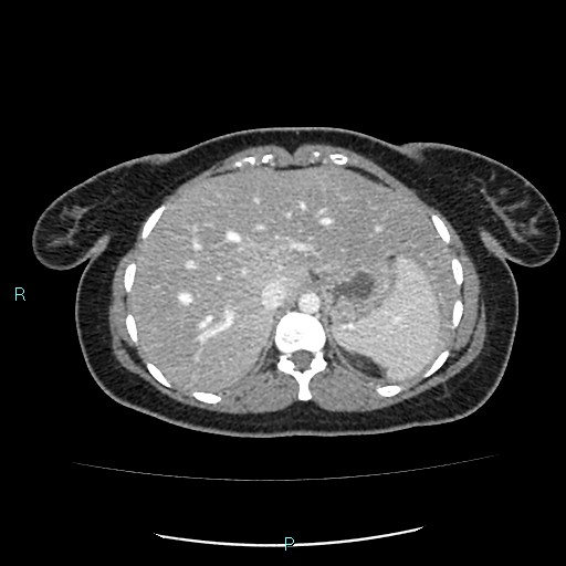 Acute bilateral pyelonephritis (Radiopaedia 37146-38881 Axial C+ portal venous phase 19).jpg