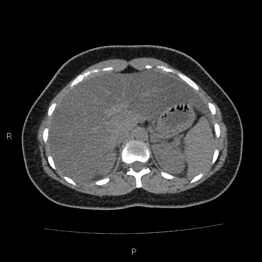 Acute bilateral pyelonephritis (Radiopaedia 37146-38881 Axial non-contrast 27).jpg