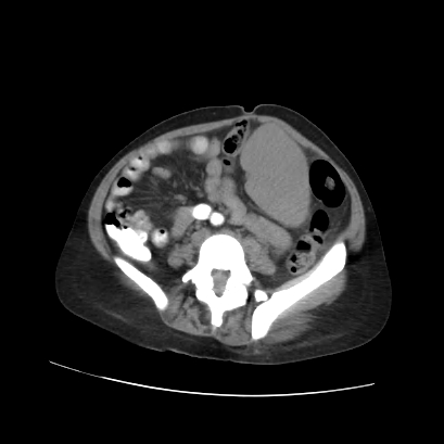 File:Acute calculous cholecystitis in patient with osteopetrosis (Radiopaedia 77871-90159 Axial non-contrast 55).jpg