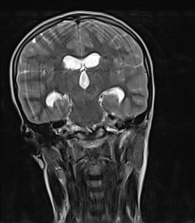 File:Acute cerebellar ataxia (Radiopaedia 61487-69446 Coronal T2 8).jpg