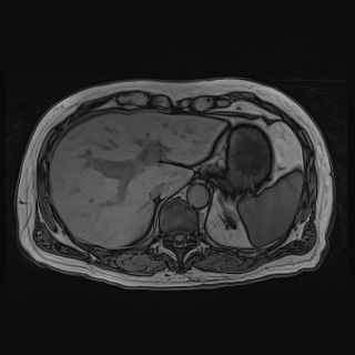 Acute cholecystitis (Radiopaedia 72392-82923 Axial T1 out-of-phase 37).jpg