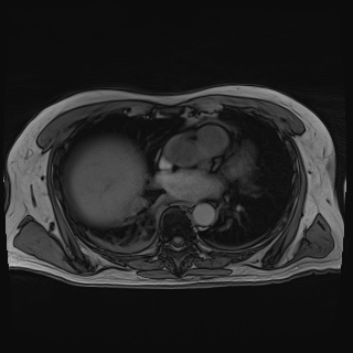 File:Acute cholecystitis (Radiopaedia 72392-82923 Axial T1 out-of-phase 9).jpg