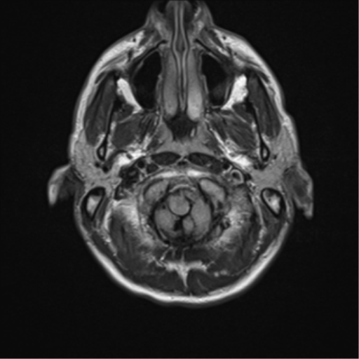 File:Acute disseminated encephalomyelitis (ADEM) (Radiopaedia 65319-74349 Axial FLAIR 3).png
