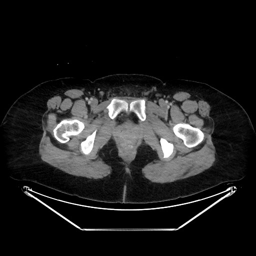 Acute diverticulitis - transverse colon (Radiopaedia 87063-103327 Axial C+ portal venous phase 170).jpg
