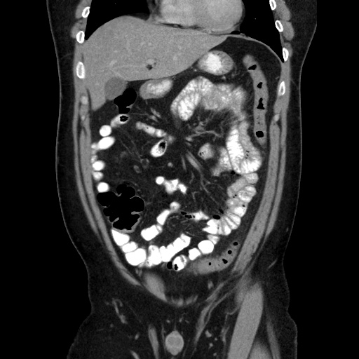 Acute diverticulitis with localized perforation (Radiopaedia 41296-44113 Coronal C+ portal venous phase 24).jpg