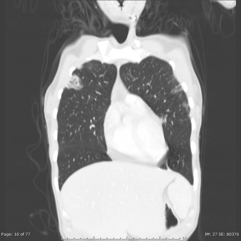Acute eosinophilic pneumonia (Radiopaedia 48211-53073 Coronal lung window 9).jpg