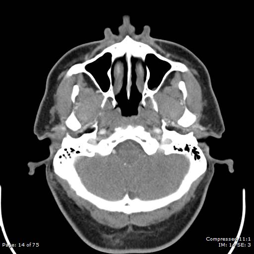 File:Acute epiglottitis (Radiopaedia 54375-60590 Axial C+ arterial phase 14).jpg