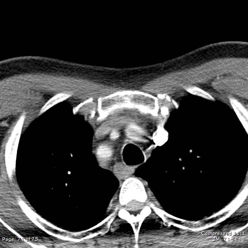 Acute epiglottitis (Radiopaedia 54375-60590 Axial C+ arterial phase 71).jpg