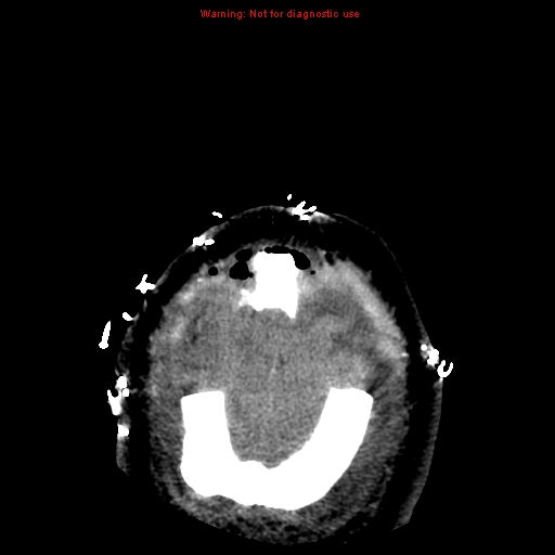 Acute hemorrhagic leukoencephalitis (Radiopaedia 14076-43697 Axial non-contrast 47).jpg