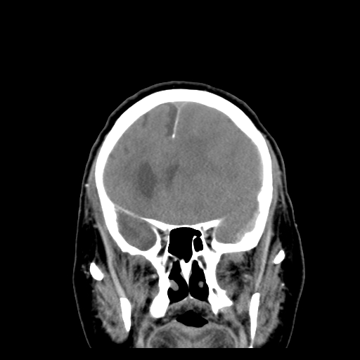 File:Acute hemorrhagic stroke (Radiopaedia 17507-17223 Coronal non-contrast 16).jpg