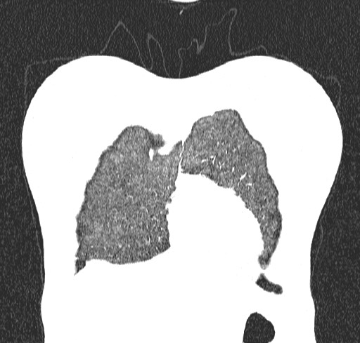 Acute hypersensitivity pneumonitis (Radiopaedia 85293-100870 Coronal lung window 8).jpg