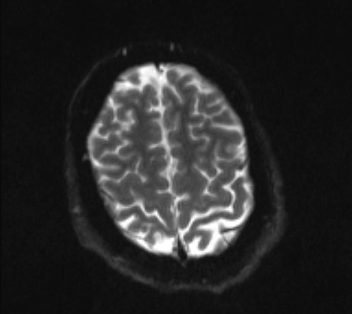 Acute ischemic stroke - posterior circulation territory (Radiopaedia 77670-89880 Axial DWI 20).jpg