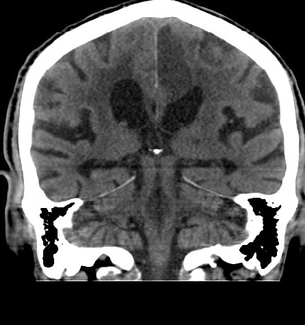 Acute left anterior cerebral artery territory infarction (Radiopaedia 51785-57578 Coronal non-contrast 37).jpg