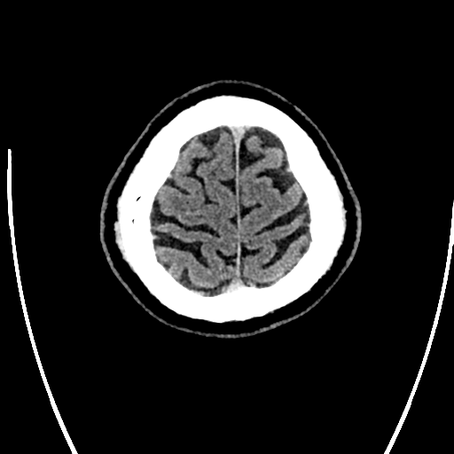 Acute left middle cerebral artery territory ischemic stroke (Radiopaedia 35688-37223 Axial non-contrast 78).png