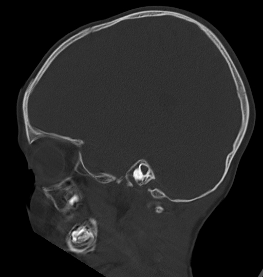 Acute mastoiditis (Radiopaedia 82678-96881 Sagittal bone window 44).jpg