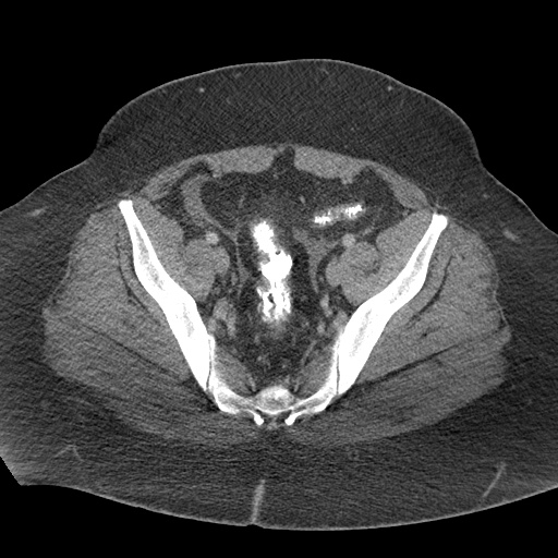 Acute mesenteric venous ischemia (Radiopaedia 46041-50383 Axial C+ portal venous phase 118).jpg
