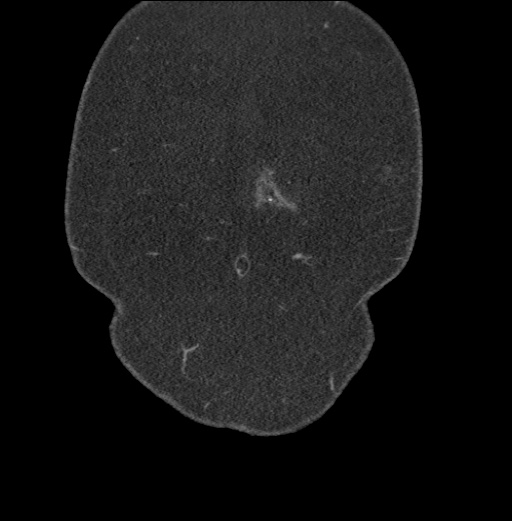 File:Acute mesenteric venous ischemia (Radiopaedia 46041-50383 Coronal C+ portal venous phase 4).jpg