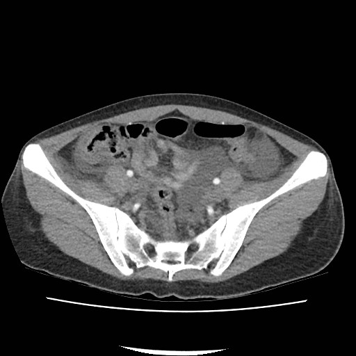 Acute myocarditis (Radiopaedia 55988-62613 Axial C+ portal venous phase 60).jpg