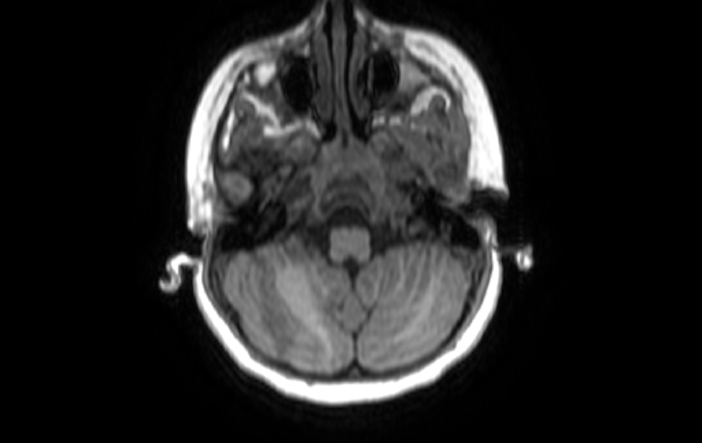 Acute necrotizing encephalitis of childhood (Radiopaedia 67356-76737 Axial T1 79).jpg