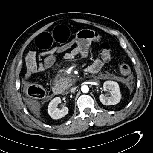 File:Acute pancreatic necrosis (Radiopaedia 13560-13486 Axial C+ portal venous phase 65).jpg