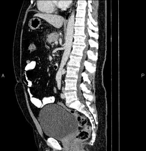 File:Acute pancreatitis (Radiopaedia 85390-101010 Sagittal C+ portal venous phase 53).jpg