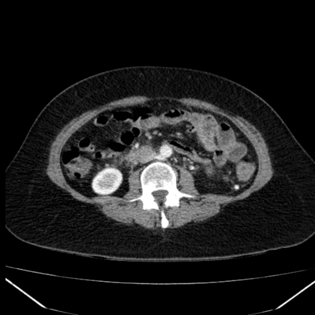 Acute pancreatitis - Balthazar C (Radiopaedia 26569-26714 Axial C+ arterial phase 48).jpg