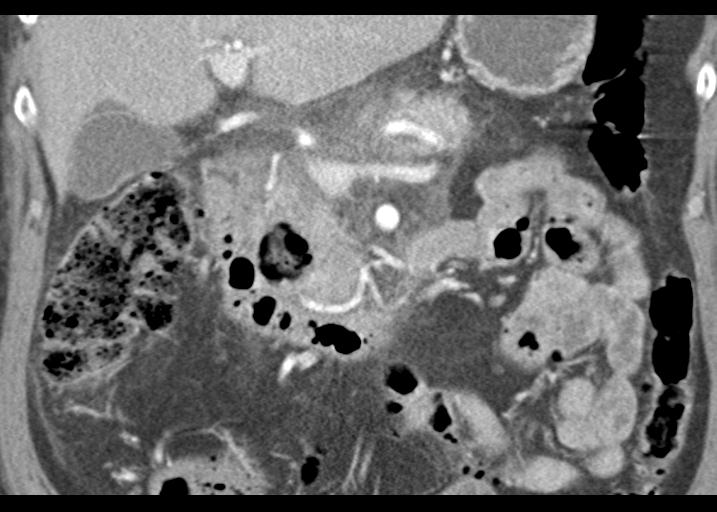 Acute pancreatitis and walled-off necrosis (Radiopaedia 29888-30403 Coronal C+ portal venous phase 26).jpg