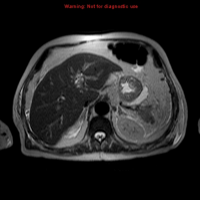 File:Acute pancreatitis with incidental pancreatic lipoma (Radiopaedia 10190-10732 Axial T2 17).jpg